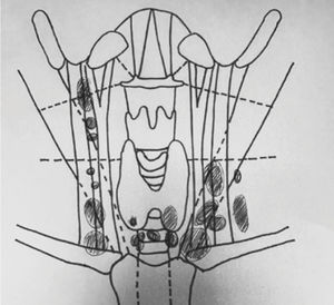 Esquema de etapificación ecográfica preoperatoria.