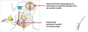 Esquema de monitorización continua del NLI. Evidencias funcionales y dinámicas obtenidas mediante neuromonitorización intraoperatoria mejorando los estándares de la tiroidectomía. Permiso de reutilización bajo la licencia: CC BY-NC Nurcihan Aygun.SiSli Etfal Hastanesi Tip Bulteni/The Medical Bulletin of Sisli Hospital 2021 Jul 2;55(2):146-155.