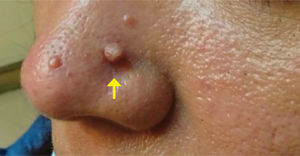 Angiofibroma nasal Con permiso de reproducción de García, et al. (2023)19.