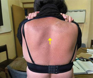 Amiloidosis cutánea liquenificada en la región interescapular. Con permiso de reproducción de García, et al. (2023)19.
