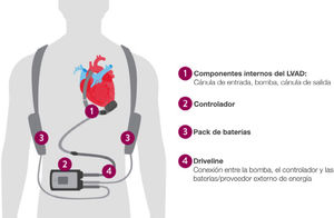 Componentes de un LVAD (HeartMate 3©, Abbott).