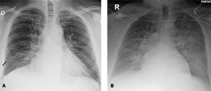 Radiografía de tórax A: En proyección posteroanterior (PA) que muestra opacidades instersticiales de predominio basal, con presencia de líneas B de Kerley (flecha negra), hallazgos compatibles con edema pulmonar intersticial. B: Radiografía portátil de tórax en proyección anteroposterior (AP), que muestra opacidades bilaterales de distribución central predominante, sugestivas de edema pulmonar alveolar, y aumento difuso de la densidad craneocaudal compatible con derrame pleural.