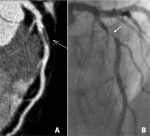 a y 2b. Ateromatosis de arteria descendente anterior (flechas blancas), con reconstrucción multiplanar en TC cardíaca que demuestra placa fundamentalmente no calcificada que determina estenosis mayor a 70% (a), y angiografía convencional que confirma una estenosis severa (b). Figura 2c. TC con reconstrucción en el eje corto que demuestra placa con características de alto riesgo en arteria descendente anterior (flecha amarilla), con placa de baja densidad con remodelamiento positivo y calcificación puntiforme.