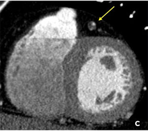 a y 2b. Ateromatosis de arteria descendente anterior (flechas blancas), con reconstrucción multiplanar en TC cardíaca que demuestra placa fundamentalmente no calcificada que determina estenosis mayor a 70% (a), y angiografía convencional que confirma una estenosis severa (b). Figura 2c. TC con reconstrucción en el eje corto que demuestra placa con características de alto riesgo en arteria descendente anterior (flecha amarilla), con placa de baja densidad con remodelamiento positivo y calcificación puntiforme.
