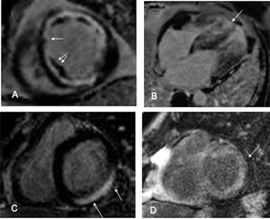 Cardio RM Realce Tardío. A- Patrón isquémico, con RT subendocárdico (flecha) que refleja necrosis celular. Las zonas hipointensas en el espesor del realce corresponden a obstrucción microvascular (flecha doble) B- Miocardiopatía hipertrófica, con hipertrofia de pared, con patrón parcheado intramiocárdico (flecha) reflejando fibrosis. C- Miocarditis, con patrón subepicárdico (flechas) que evidencia inflamación con daño celular. D- Amiloidosis, con patrón subendocárdico-transmural difuso (flecha), que refleja la infiltración del miocardio por proteínas de amiloide con aumento del VEC.