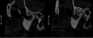 Tomografía computarizada. Corte sagital de articulaciones temporomandibulares, boca cerrada. Alteración articular izquierda, erosión y pérdida importante del espacio articular en ambas superficies.