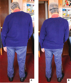 A. Imagen del usuario en plano frontal, bipedestación relajada. B. Imagen del usuario en plano frontal, con corrección postural voluntaria de cabeza.