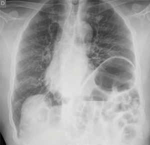 Radiografía de tórax. Vista anteroposterior, se observa ascenso del hemidiafragma izquierdo con acompañamiento del estómago. Signos de congestión pulmonar con redistribución apical y algunas líneas B de Kerley y desviación derecha de la columna dorsal.