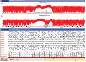 Diferentes tipos de montajes. Figura obtenida de la publicación “Acute neonatal encephalopathy and seizures recurrence: a combined aEEG/EEG study” (Mastrangelo et al.)21, donde se muestra trazado de aEEG, donde los corresponden a crisis subintrantes y la elevación de la línea de base, a EE.