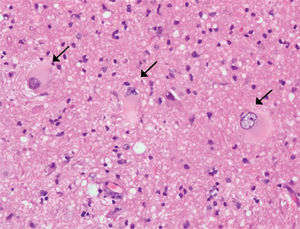 Biopsia cerebral, tinción HE, aumento 40x. Flechas: Ballon cells.