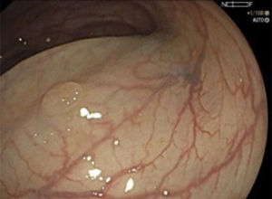Visualización endoscópica de un pólipo de colon.