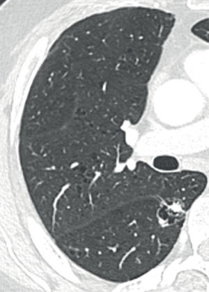 Corte axial de tomografía computada que demuestra quiste atípico en lóbulo inferior derecho con áreas nodulares irregulares sólidas, en paciente con cáncer de próstata. Fue resecada e informada como adenocarcinoma pulmonar. Además, se observa enfisema centrolobulillar.