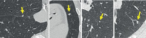 Cortes axiales ampliados de tomografía computada de pulmón. Se observan nódulos de aspecto benigno compatibles con linfonodos intrapulmonares (flechas), sólidos con configuración triangular, ovoidea o lenticular, yuxtacisurales.