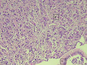 Hematoxylin and eosin staining of a gastric specimen showing simple glandular epithelium (1) and poorly cohesive neoplastic cells with signet-ring cell features (2) (×200).