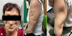 Paniculitis lúpica. Depresión cutánea lipoatrófica en región cigomática, con piel suprayacente aparentemente sana. Asociada a nódulos subepidérmicos palpables (A); Lipoatrofia en forma de “hoyuelo” en brazo proximal, secundaria a resolución de nódulos inflamatorios (B); Lesión activa en muslo: placa eritematosa sobre paniculitis con signos de atrofia grasa periférica (C).
