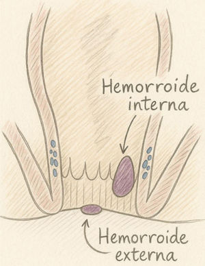 Hemorroides. Representación de la localización de las hemorroides internas y externas. Fuente: elaboración propia.