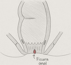Fisura anal Fuente: elaboración propia.