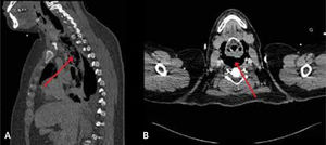 Tomografía computada de cuello y tórax Se observa una mediastinitis necrotizante descendente (flechas) con extenso enfisema multicompartimental secundario a perforación de hipofaringe por cuerpo extraño. A) Corte sagital; B) Corte axial.