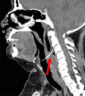 Tomografía computada de paciente con infección cervical profunda. Corte sagital que muestra flegmón retrofaríngeo secundario a perforación por cuerpo extraño correspondiente a hueso de conejo (flecha).