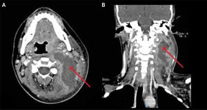 Tomografía computada de paciente con absceso Gran absceso multicompartimental en espacios paravertebral, parafaríngeo y carotídeo izquierdo (flecha). A) Corte axial; B) Corte coronal.