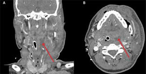 Tomografía computada de cuello Se observa una zona hipodensa compatible con un absceso parafaríngeo izquierdo (flecha). A) Corte coronal; B) Corte axial.