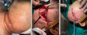 Drenaje de absceso parafaríngeo izquierdo Imagen central muestra cervicotomía izquierda y disección por borde anterior del esternocleidomastoídeo (flecha). Imagen derecha muestra instalación de drenaje aspirativo.