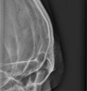 Radiografía localizada del hemangioma de la región frontal de la calota que presenta un patrón trabecular en “panal de abejas” o “rueda de carreta”.