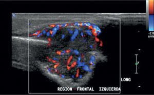 US Doppler color revela una lesión hipervascular, que correspondió a metastasis.