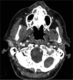 TC muestra un tumor sólido mal definido adyacente al ángulo mandibular, con moderado realce. Biopsia demostró metastásis.