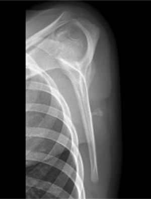 Radiografía convencional demuestra un osteocondroma escapular.