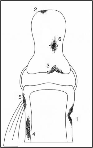 Esquema de tipos de resorción ósea. Resorción subperióstica (1), acroosteólisis (2), resorción subcondral (3), resorción intracortical (4), resorción subtendínea (5) y resorción de hueso trabecular (6).