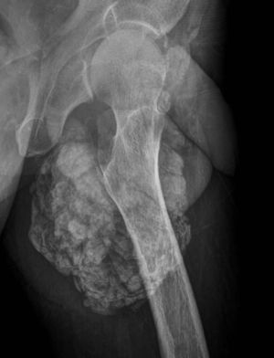 Radiografía de cadera izquierda en proyección axial. Se observan múltiples calcificaciones periarticulares, configurando un aspecto pseudotumoral de la lesión.