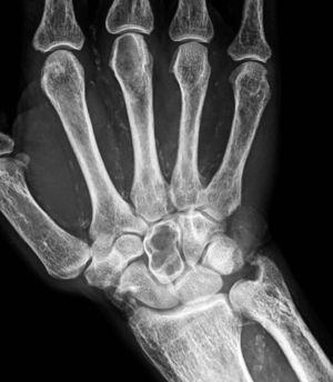 Radiografía de mano en proyección anteroposterior de un paciente con hiperparatiroidismo secundario y enfermedad renal crónica, donde se muestra una lesión lítica de borde bien definido que afecta de forma difusa al hueso grande derecho, de 18mm de diámetro.
