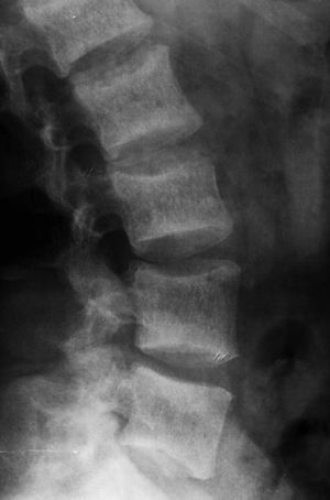 Radiografía de columna lumbar en proyección lateral donde se observan múltiples cuerpos vertebrales con áreas radioopacas subcondrales alternadas con áreas radiolúcidas centrales, dando un aspecto en «camiseta de rugby».