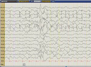 EEG en sueño realizado durante el PET: Actividad epileptiforme continua tipo espiga-onda fronto-centro-temporal izquierda que ocupa más del 85% del sueño No REM, muy frecuentes de observar en los trazados superiores (T3-T5, F7-T3, C3-P3).