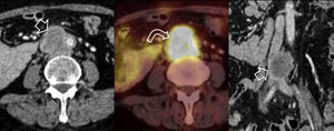 Cortes axiales de TC y PET/TC (imagen híbrida de tomografía de emisión de positrones y tomografía computarizada) y reconstrucción coronal de TC, en donde se demuestra una lesión sólida mal delimitada ubicada en la región retroperitoneal en situación inter-aorto-cava, la cual contacta e invade a la VCI (flecha recta). La masa tumoral presenta importante captación del trazador, incluido el componente intraluminal (flecha curva). En la reconstrucción coronal es posible visualizar de mejor forma la invasión de la VCI. La biopsia evidencia un sarcoma retroperitoneal de alto grado.