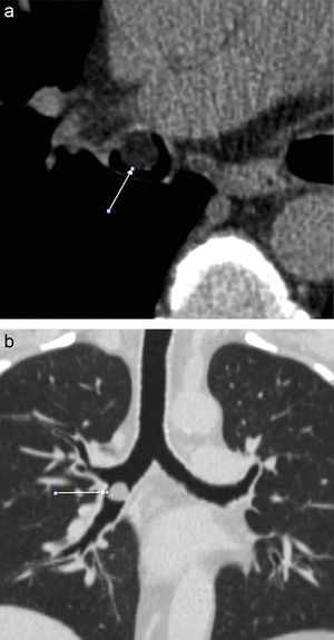 Lipoma endobronquial que se manifestó como una masa de atenuación grasa. Imagen axial donde se visualiza el lipoma a nivel del bronquio intermediario. Reconstrucción coronal en ventana de pulmón.