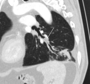 Reconstrucción oblicua en ventana de pulmón donde se observa el hamartoma lipomatoso, la dilatación bronquial secundaria a este y la neumonía segmentaria obstructiva.