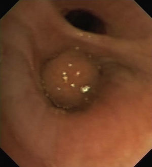 Imagen de fibrobroncoscopia donde se observa el hamartoma.