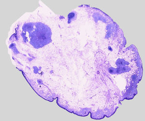 Microfotografía de la lesión. Tumoración benigna de predominio lipomatoso con áreas focales periféricas de cartílago maduro.
