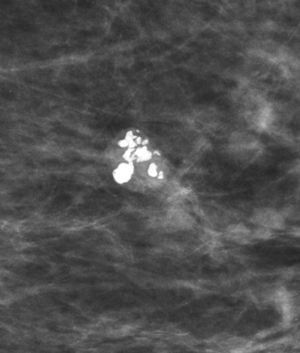 Calcificaciones en pop corn: Se observa un nódulo con gruesas calcificaciones, algunas confluentes. Diagnóstico presuntivo: fibroadenoma involutivo.