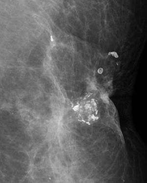 Calcificaciones distróficas. Son calcificaciones gruesas, con áreas radiolúcidas, en relación a una zona de distorsión de la arquitectura, en una paciente operada de un carcinoma invasor.