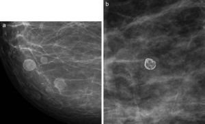 a. Calcificaciones en anillo. Antiguamente llamadas quistes oleosos, corresponden a lesiones redondeadas, de baja densidad, con finas calcificaciones iniciales periféricas en una paciente con antecedente de trauma local. b. Calcificaciones en anillo. Lesión esférica, con una superficie calcificada delgada, a través de la cual se visualiza un centro radiolúcido.