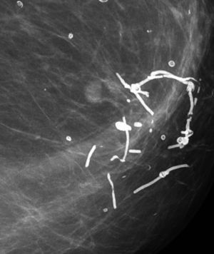 Calcificaciones de suturas. Se observa calcificaciones que forman nudos, típicamente benignas. Adyacente a estas es posible ver algunas pequeñas calcificaciones en anillo.