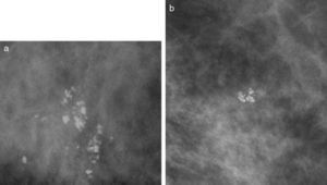 a. Calcificaciones groseras heterogéneas. Son calcificaciones agrupadas, de forma irregular, nítidas, con tendencia a coalescer. Biopsia estereotáxica BED: hiperplasia fibroadenomatosa con esclerosis estromal y calcificaciones distróficas asociadas a ectasia ductal y mastitis crónica periductal. b. Calcificaciones groseras heterogéneas. Calcificaciones toscas, gruesas, irregulares. BED: fibroadenoma hialinizado.