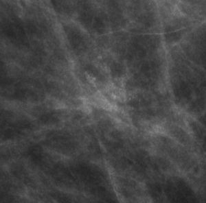 Microcalcificaciones amorfas. Grupo de microcalcificaciones tenues, amorfas. BED: Atipia plana y adenosis esclerosante.