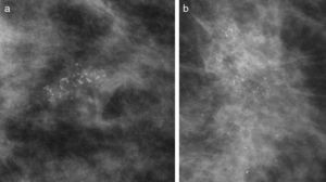 a. Microcalcificaciones finas pleomorfas. Son calcificaciones irregulares, de distintas formas y tamaño, de aspecto sospechoso. b. Microcalcificaciones finas pleomorfas. Asociadas a una asimetría densa y con distorsión de la arquitectura. BED: carcinoma ductal in situ de alto grado con necrosis de tipo comedocarcinoma y cancerización de lobulillos.