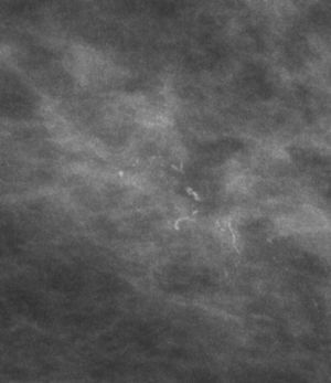 Microcalcificaciones finas, lineales y ramificadas. La biopsia estereotáxica demostró carcinoma ductal in situ de alto grado con necrosis.
