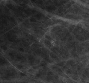 Distribución agrupada. Microcalcificaciones pleomórficas y lineales distribuidas en una pequeña área. Biopsia estereotáxica: hiperplasia ductal atípica.
