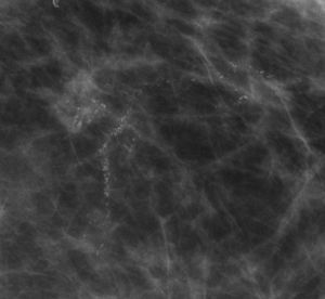 Distribución lineal. Microcalcificaciones pleomórficas que siguen la distribución de un conducto. La biopsia estereotáxica demostró carcinoma papilar intraquístico asociado a carcinoma ductal in situ de alto grado.